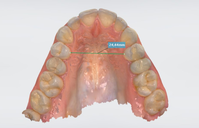 Пластинки Планаса Пластинки Планаса