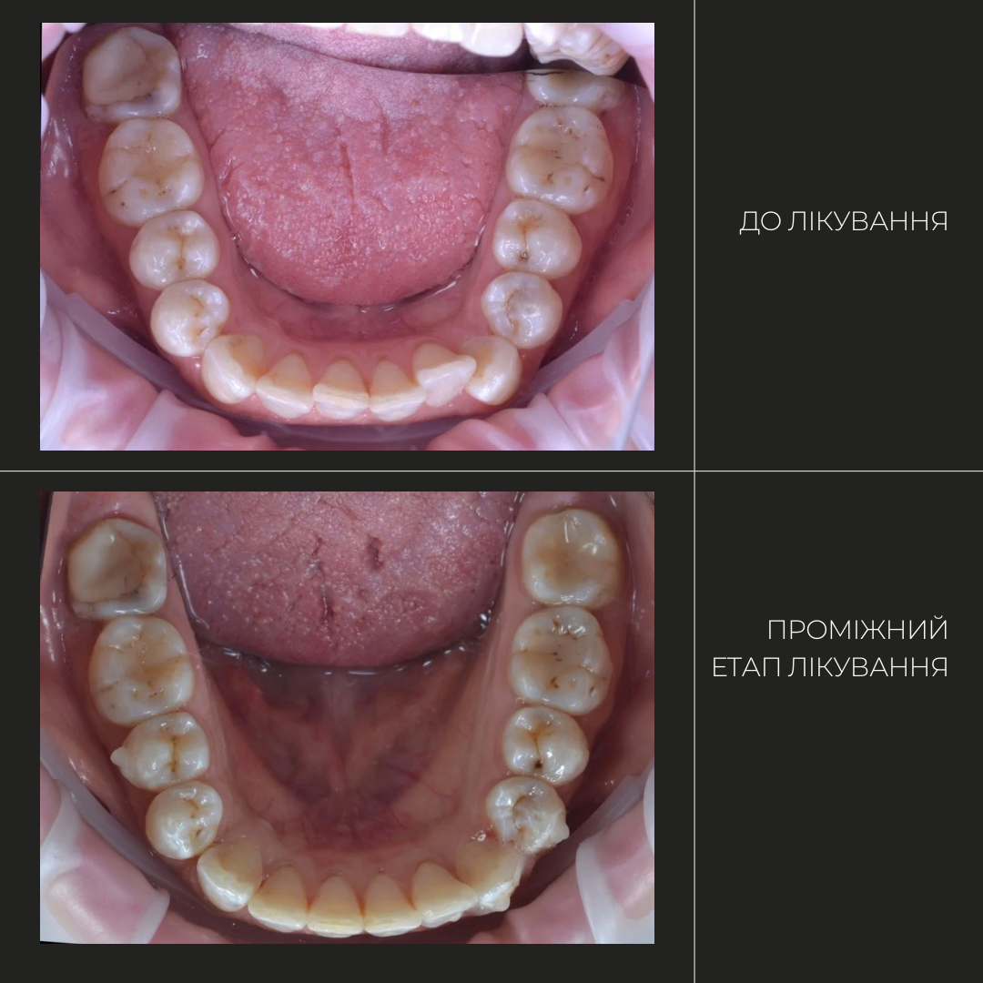 Вирівнювання зубів елайнерами Київ