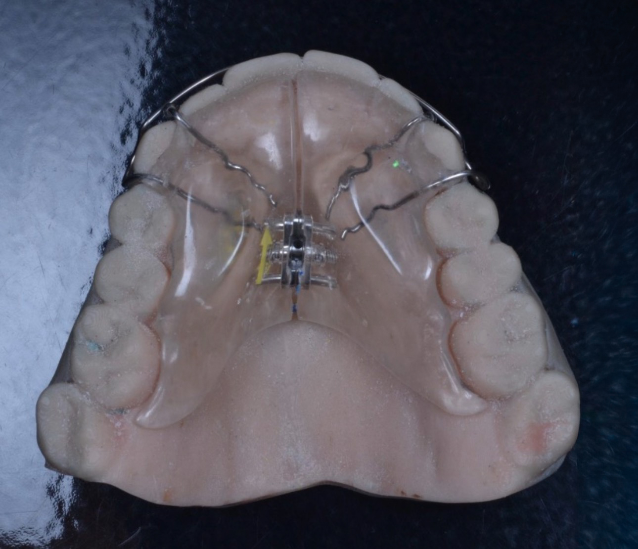 Пластинки Планаса, метод OSB